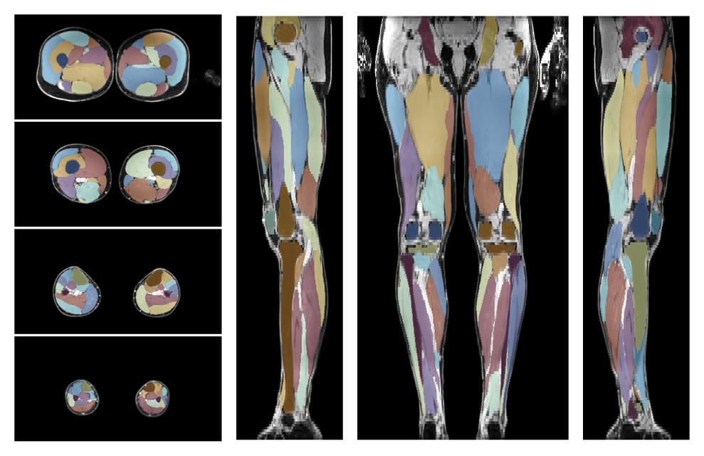 Overlay of automated muscle segmentation labels on dixon water image.